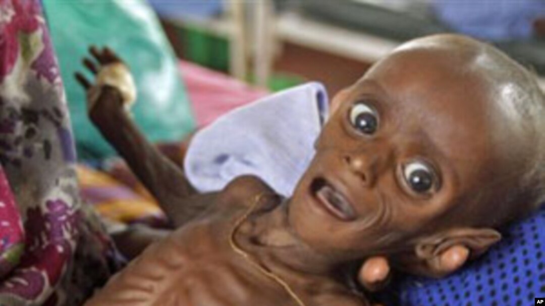 In this Tuesday, July 26, 2011 file photo, then seven month old Somali boy Minhaj Gedi Farah is treated in a field hospital of the International Rescue Committee (IRC) in Dadaab, Kenya. Somalia was hard hit by drought and parts of the country suffered fam