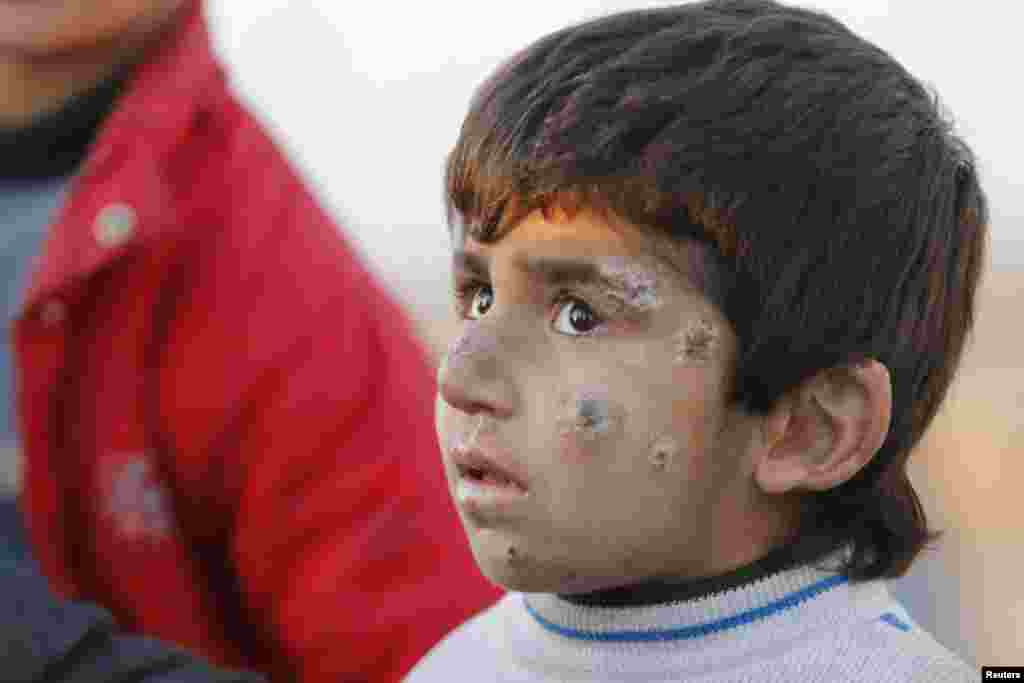 A boy from the minority Yazidi sect, bitten by mosquitoes, shows what appears to be infected bited, near Kirkuk, Jan. 17, 2015. 