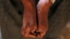 Leprosy Resurfacing in Malawi