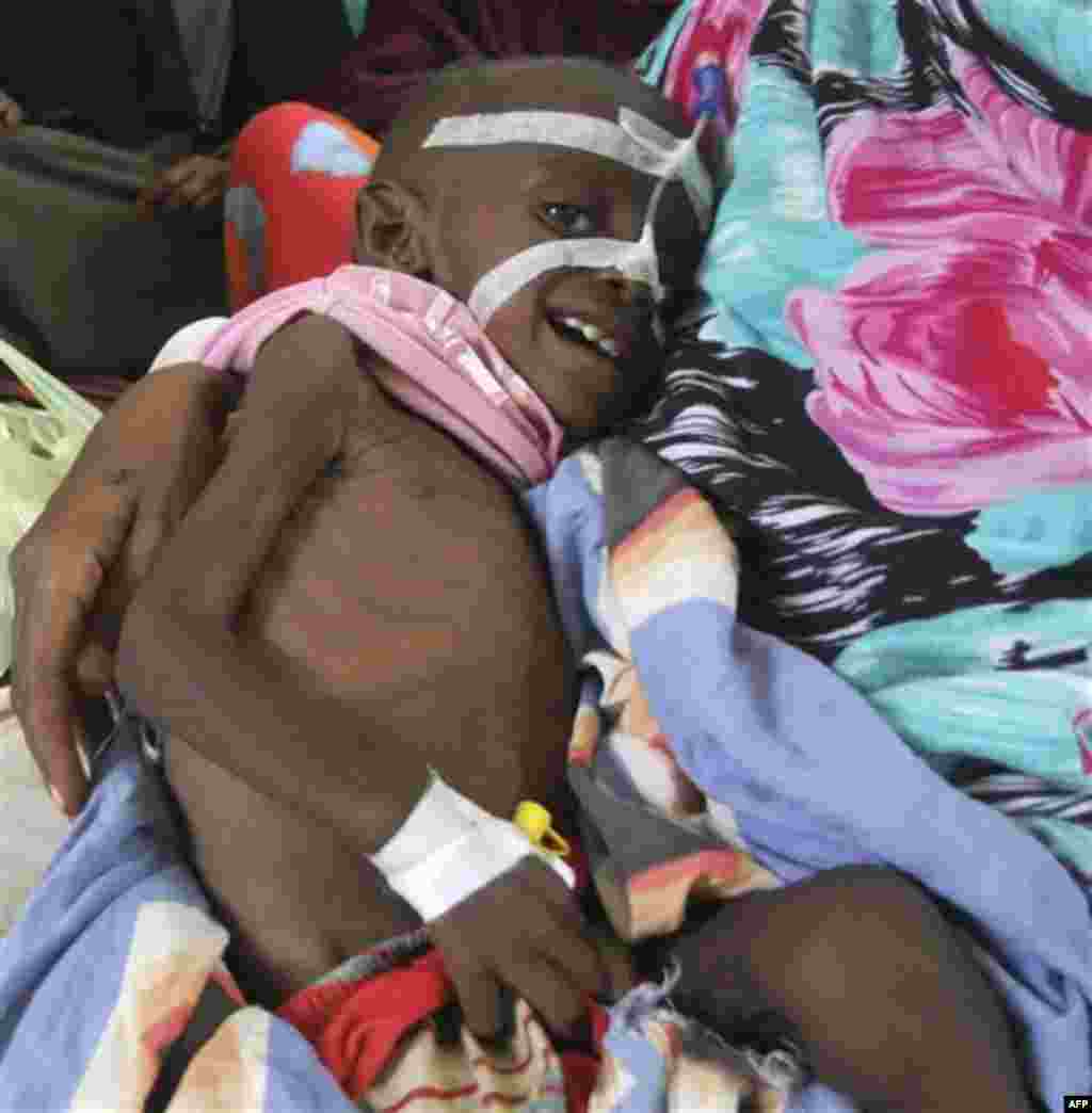 A Somali malnourished child from southern Somalia is treated in Banadir hospital in Mogadishu, Somalia, Friday, July 22, 2011. Drought and lack of food is forcing people to migrate to seek aid, with some thousands of people arriving in Mogadishu over th