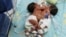 FILE - Conjoined twin girls, born in Peru in April 2015, are shown at three days old. Another set of conjoined twin girls was born in northern India Feb. 3, 2016. 