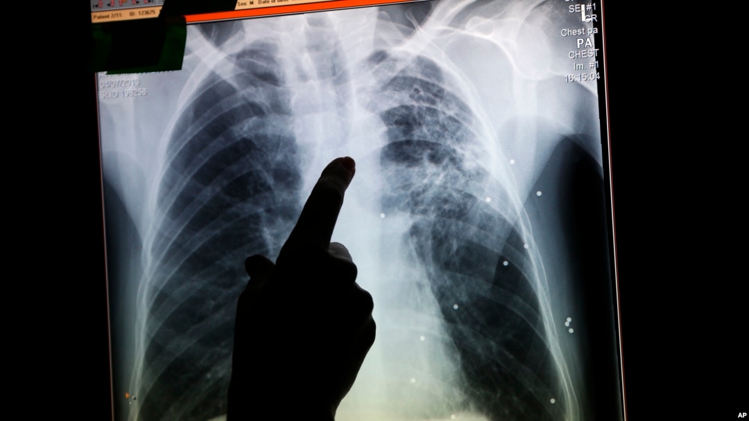 Pemindaian paru-paru penderita TB dengan menggunakan X-ray (foto: ilustrasi).